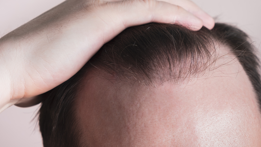 Les causes de la chute de cheveux chez les hommes