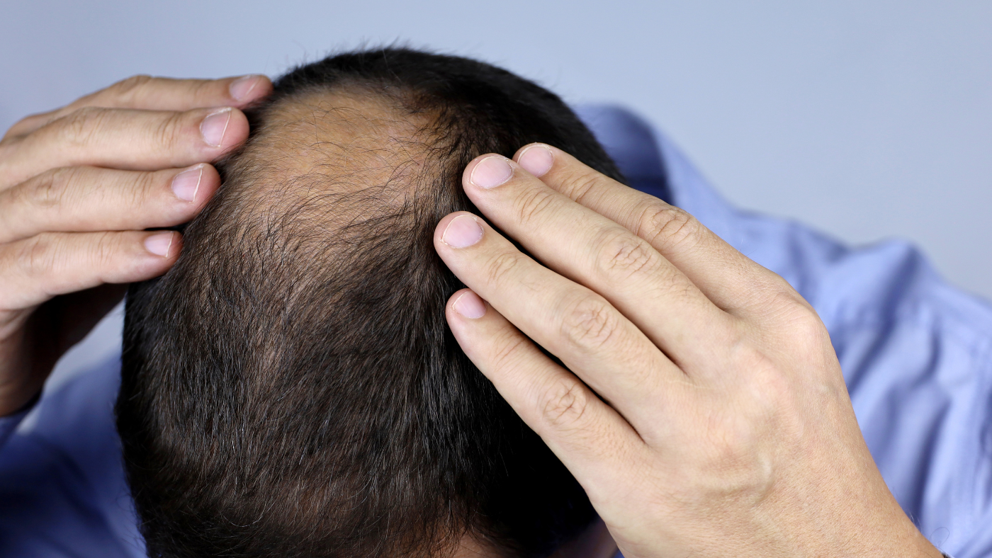 Un homme touchant ses cheveux, préoccupé par l'alopécie et la perte de cheveux.