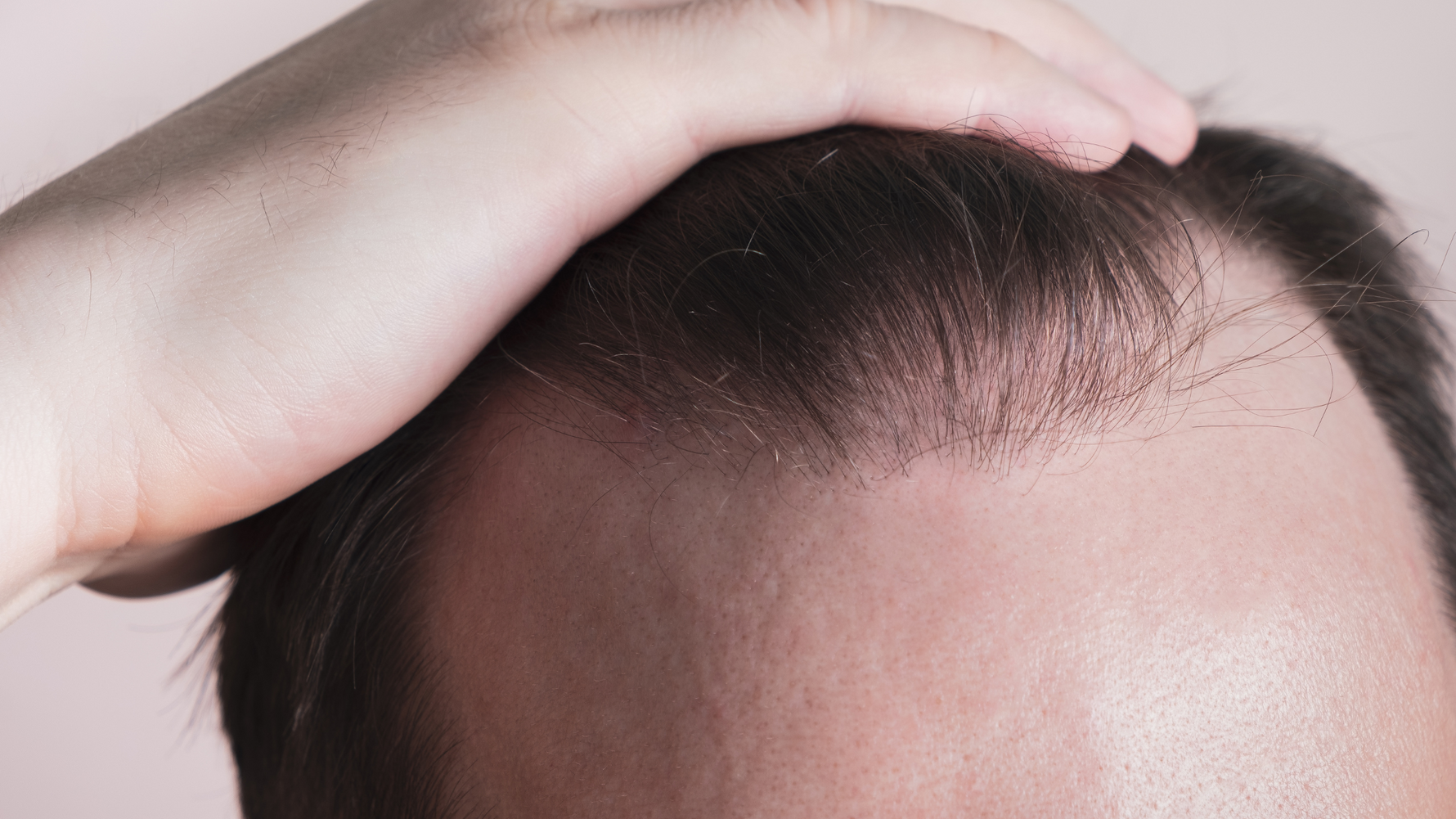 Close-up of a man's hand touching his thinning hairline, highlighting the issue of male pattern baldness and hair loss.